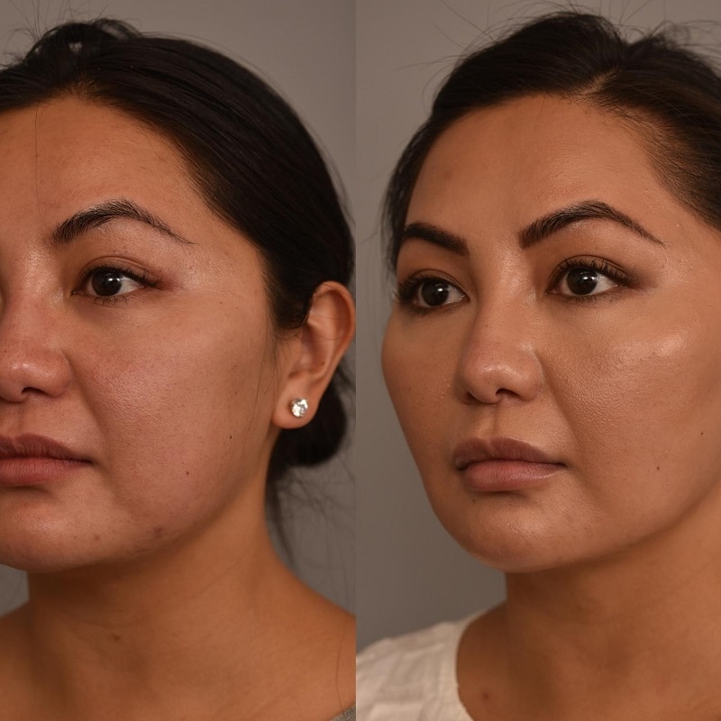 Buccal Fat Removal Before and After: What You Need to Know 13 Buccal Fat Removal Before and After: What You Need to Know