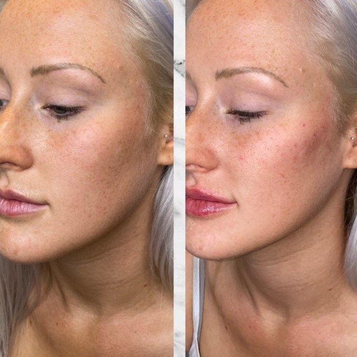 Cheek Filler Before and After: Transforming Your Appearance with Subtle Enhancements 13 Cheek Filler Before and After: Transforming Your Appearance with Subtle Enhancements