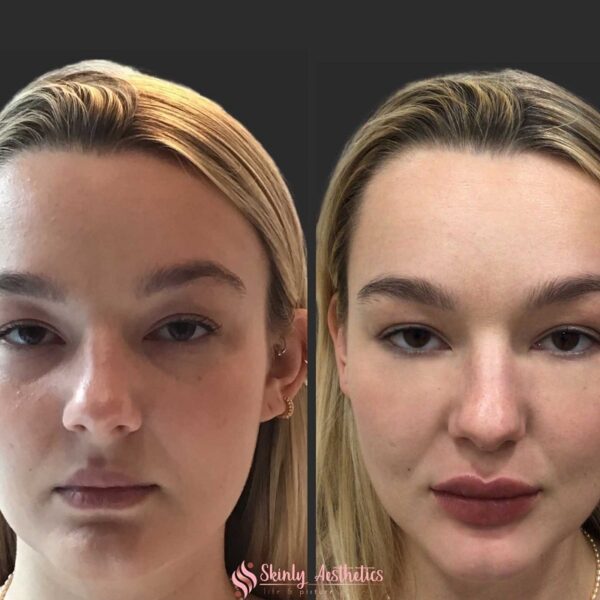 She Got Under Eye Filler! Check Out Her Stunning Before And After Photos! - 3bphk5k