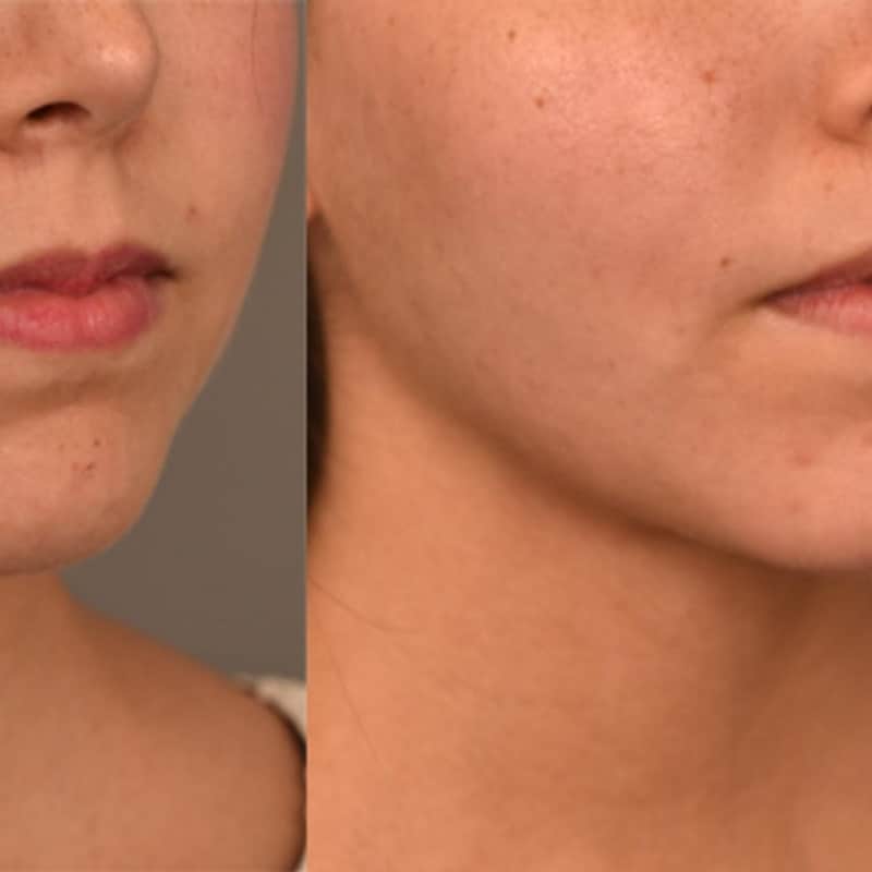 Buccal Fat Removal Before and After: What You Need to Know 14 Buccal Fat Removal Before and After: What You Need to Know