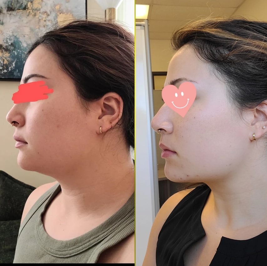 Mewing Before and After: Transforming Your Face with Proper Tongue Posture