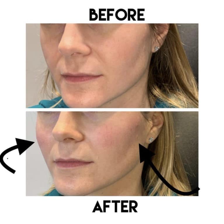 Cheek Filler Before and After: Transforming Your Appearance with Subtle Enhancements 14 Cheek Filler Before and After: Transforming Your Appearance with Subtle Enhancements