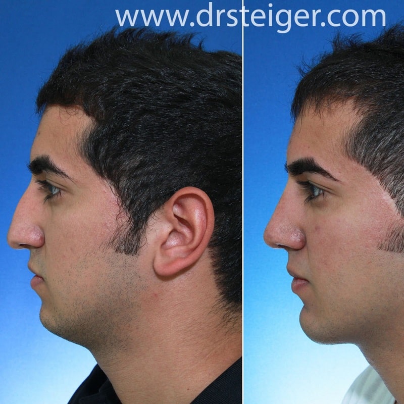 Nose Job Before and After: Dramatic Transformations and What to Expect