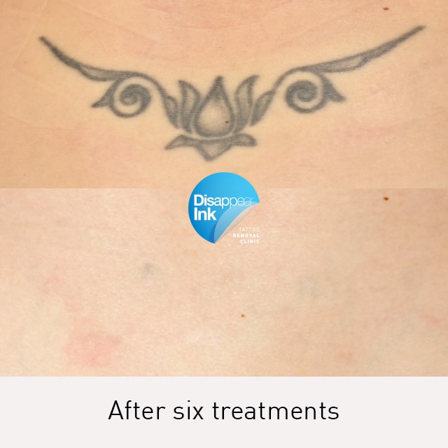 Tattoo Removal Before and After: What You Need to Know