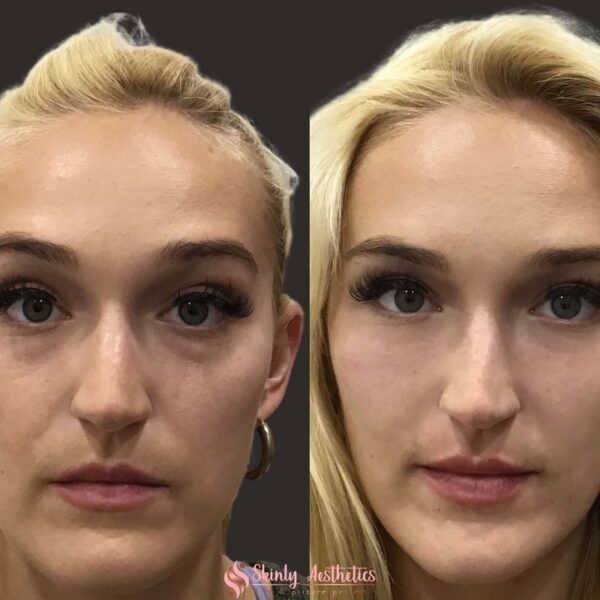 Under Eye Filler Before and After Results and Expectations Must Read