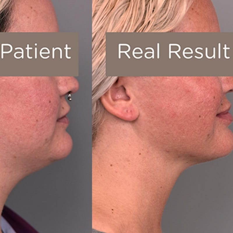 Buccal Fat Removal Before and After: What You Need to Know