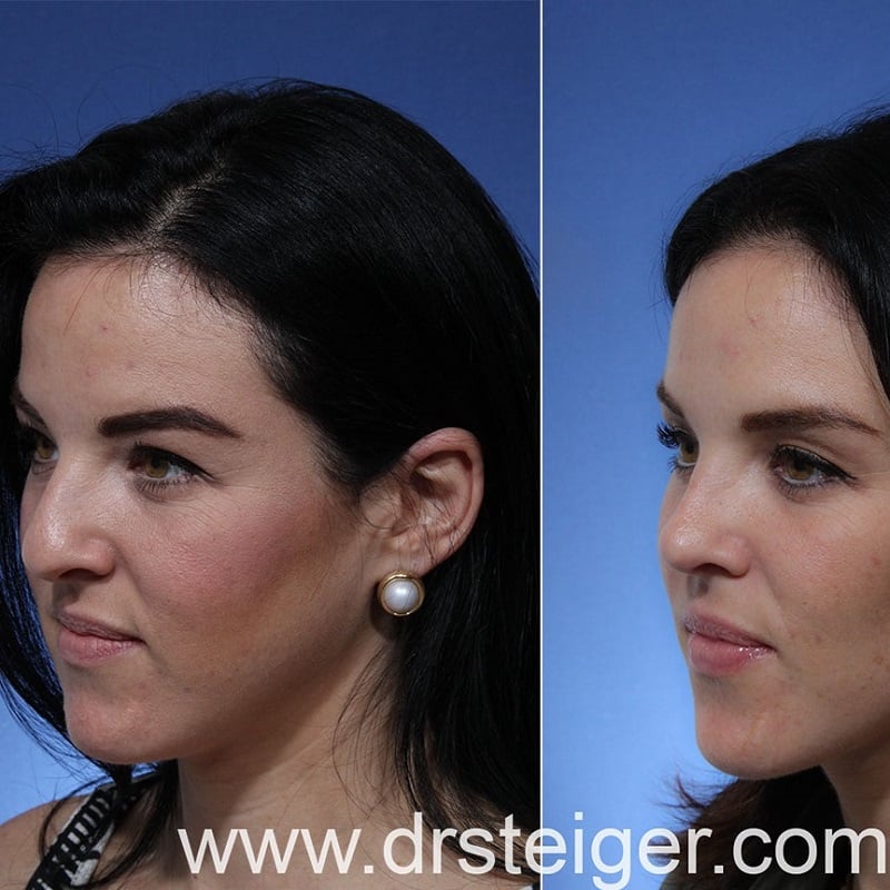 Nose Job Before and After: Dramatic Transformations and What to Expect