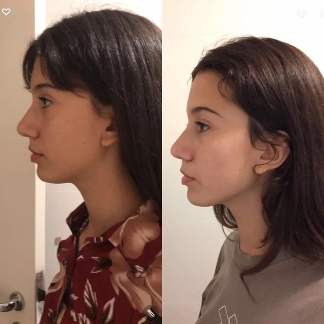 Mewing Before and After: Transforming Your Face with Proper Tongue Posture