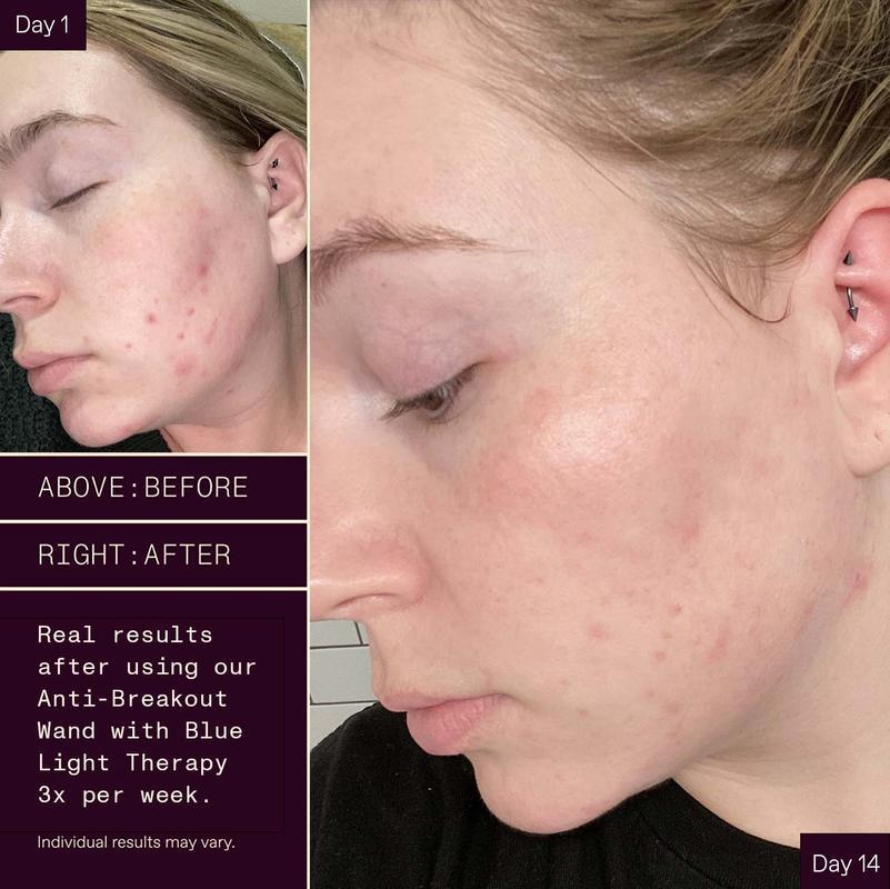 Solawave Before and After: A Comprehensive Analysis of the Results 19 Solawave Before and After: A Comprehensive Analysis of the Results