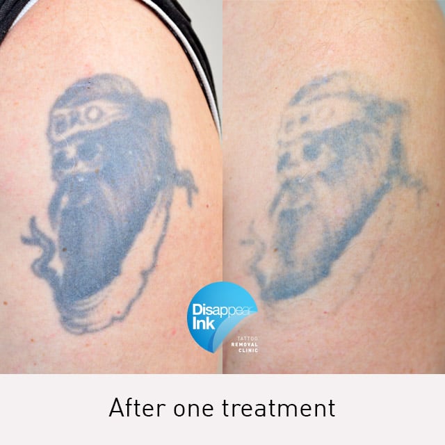 Tattoo Removal Before and After: What You Need to Know