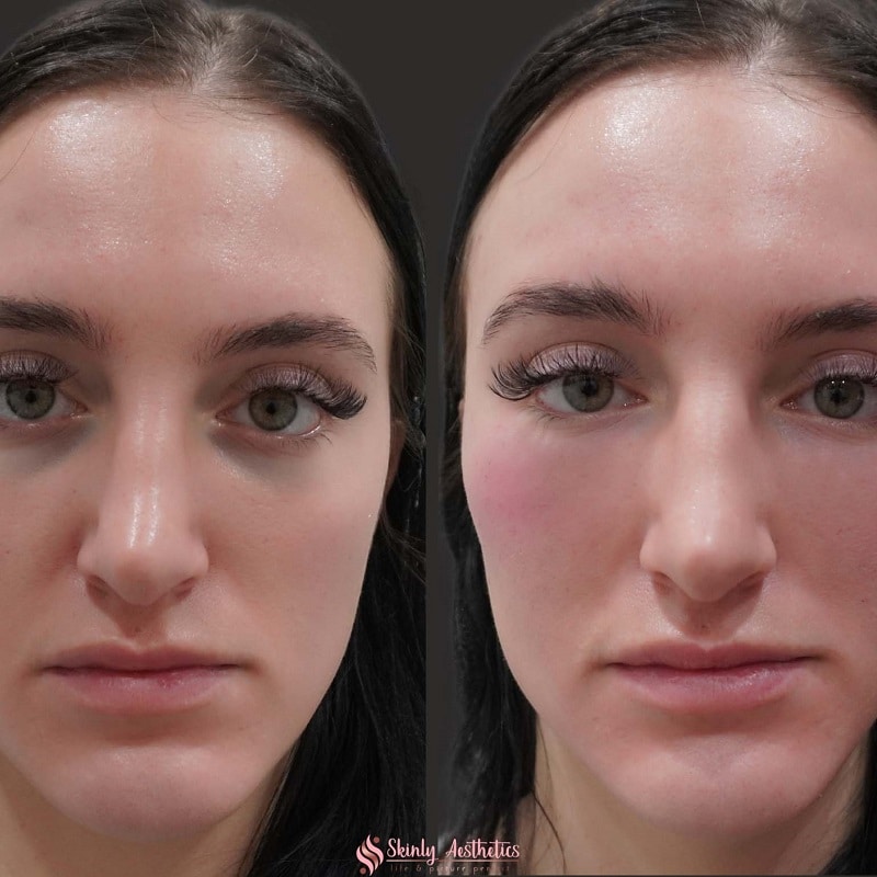 Under Eye Filler Before and After: Results and Expectations 16 Under Eye Filler Before and After: Results and Expectations