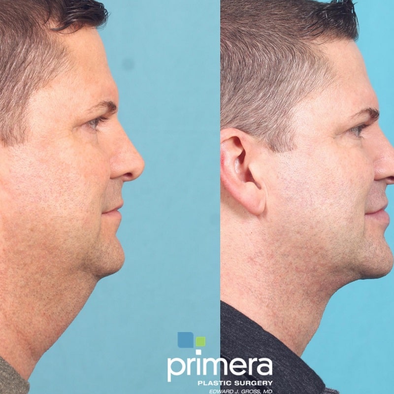 Buccal Fat Removal Before and After: What You Need to Know