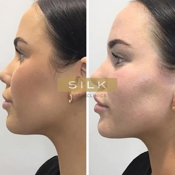 Cheek Filler Before and After: Transforming Your Appearance with Subtle Enhancements 17 Cheek Filler Before and After: Transforming Your Appearance with Subtle Enhancements
