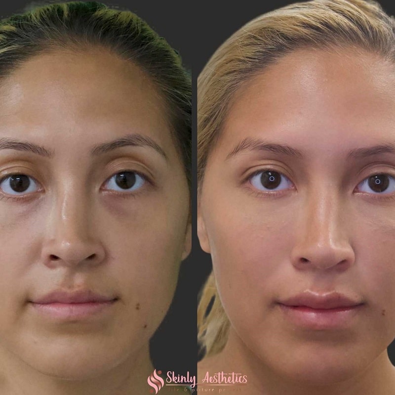Under Eye Filler Before and After: Results and Expectations 18 Under Eye Filler Before and After: Results and Expectations