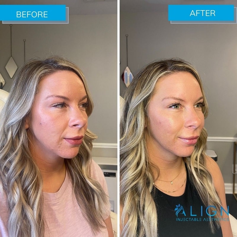Cheek Filler Before and After: Transforming Your Appearance with Subtle Enhancements 19 Cheek Filler Before and After: Transforming Your Appearance with Subtle Enhancements