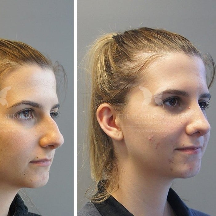 Nose Job Before and After: Dramatic Transformations and What to Expect