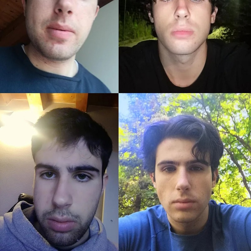 Mewing Before and After: Transforming Your Face with Proper Tongue Posture 20 Mewing Before and After: Transforming Your Face with Proper Tongue Posture