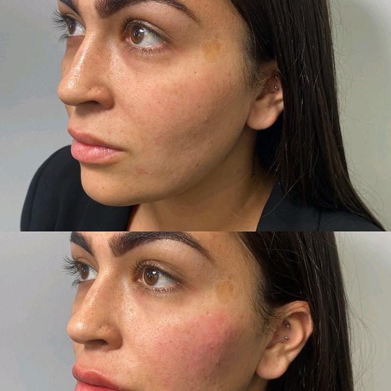 Cheek Filler Before and After: Transforming Your Appearance with Subtle Enhancements