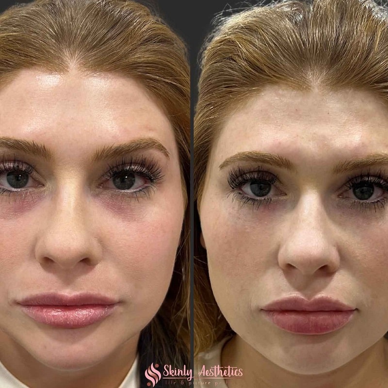 Under Eye Filler Before and After: Results and Expectations 19 Under Eye Filler Before and After: Results and Expectations