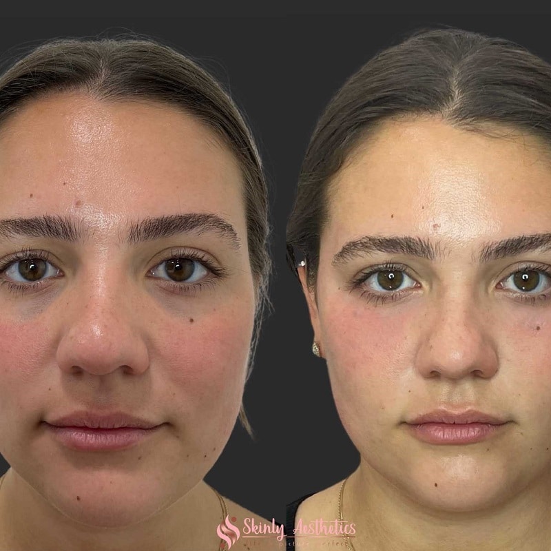 Under Eye Filler Before and After: Results and Expectations 2 Under Eye Filler Before and After: Results and Expectations