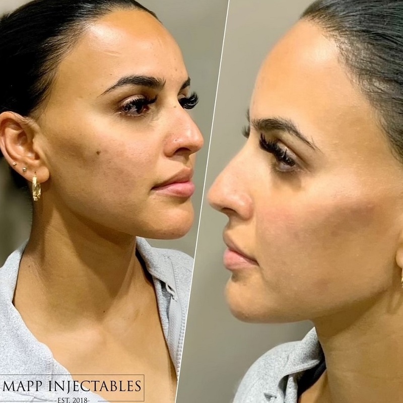 Cheek Filler Before and After: Transforming Your Appearance with Subtle Enhancements 3 Cheek Filler Before and After: Transforming Your Appearance with Subtle Enhancements