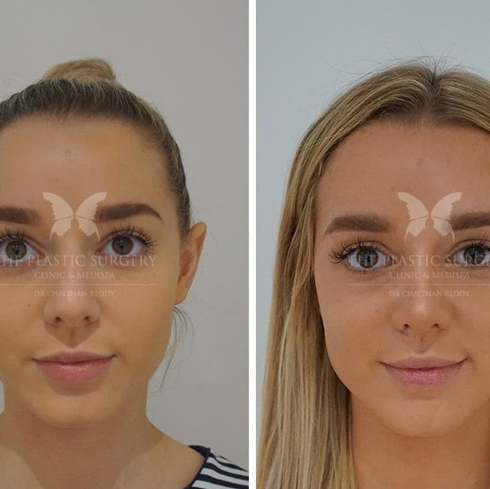 Nose Job Before and After: Dramatic Transformations and What to Expect