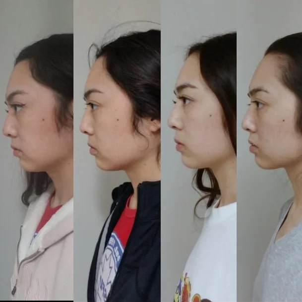 Mewing Before and After: Transforming Your Face with Proper Tongue Posture