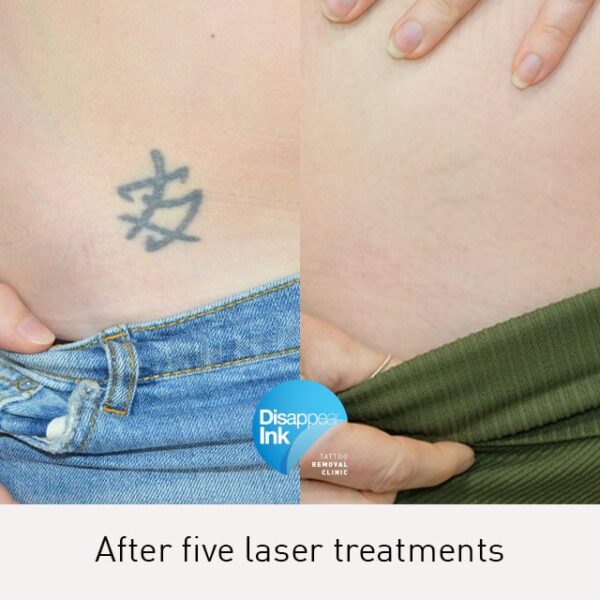 Tattoo Removal Before and After What You Need to Know Must Read This
