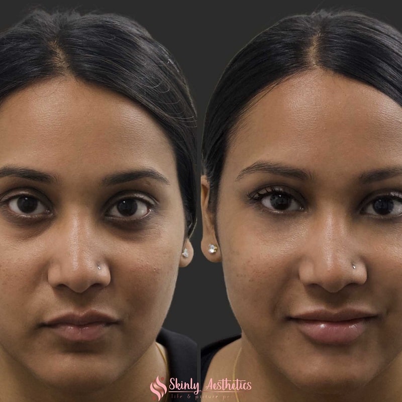 Under Eye Filler Before and After: Results and Expectations 20 Under Eye Filler Before and After: Results and Expectations