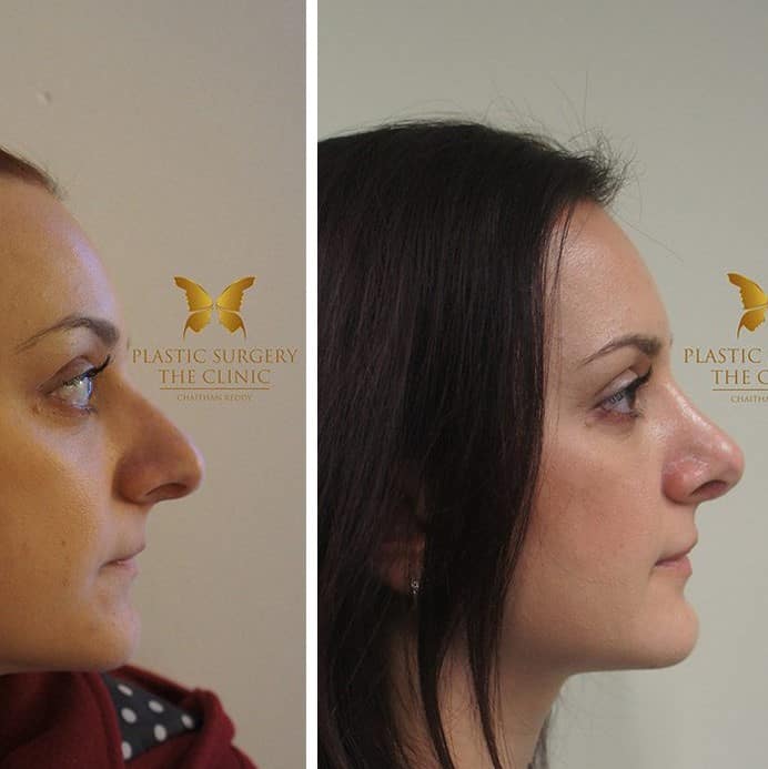 Nose Job Before and After: Dramatic Transformations and What to Expect