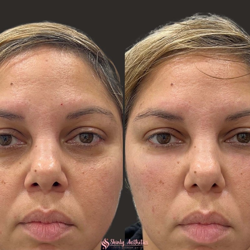 Under Eye Filler Before and After: Results and Expectations 21 Under Eye Filler Before and After: Results and Expectations