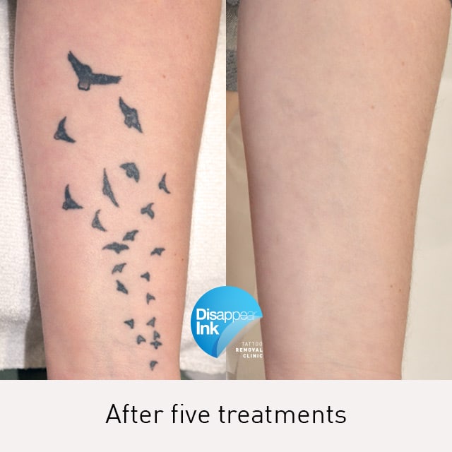 Tattoo Removal Before and After: What You Need to Know