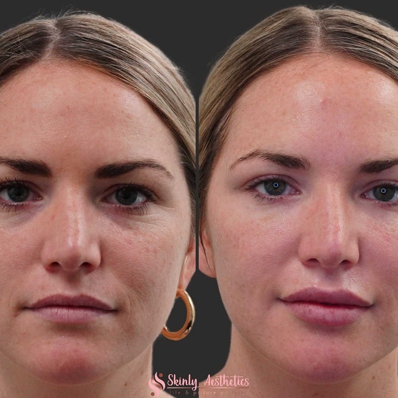 Under Eye Filler Before and After: Results and Expectations 22 Under Eye Filler Before and After: Results and Expectations