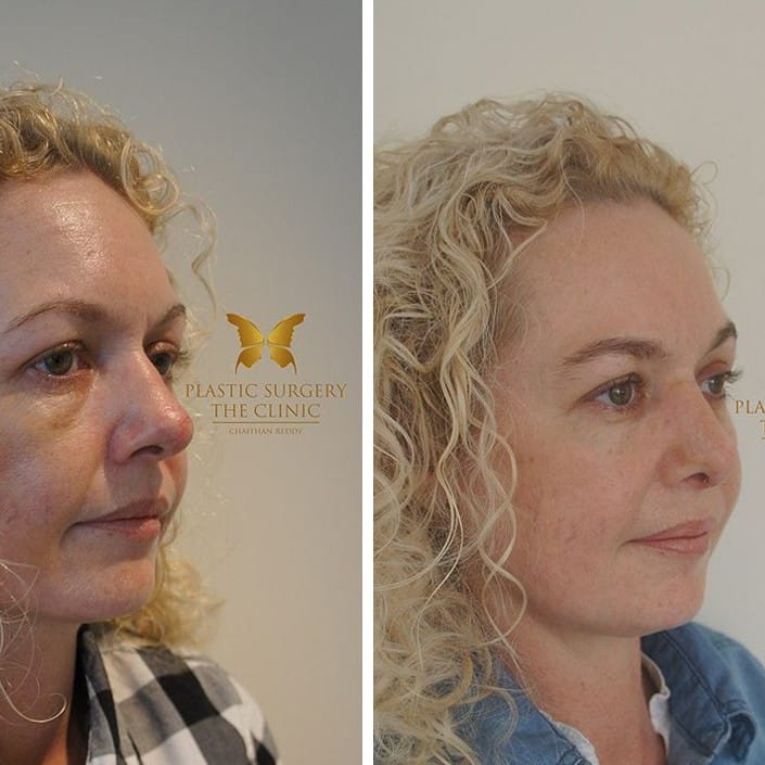 Nose Job Before and After: Dramatic Transformations and What to Expect