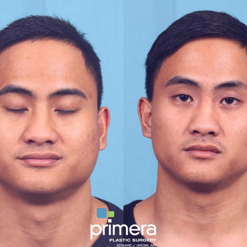 Buccal Fat Removal Before and After: What You Need to Know 24 Buccal Fat Removal Before and After: What You Need to Know