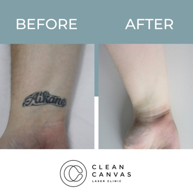 Tattoo Removal Before and After: What You Need to Know