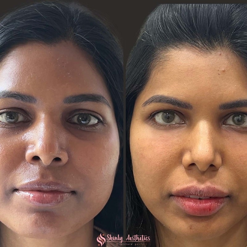 Under Eye Filler Before and After: Results and Expectations 23 Under Eye Filler Before and After: Results and Expectations