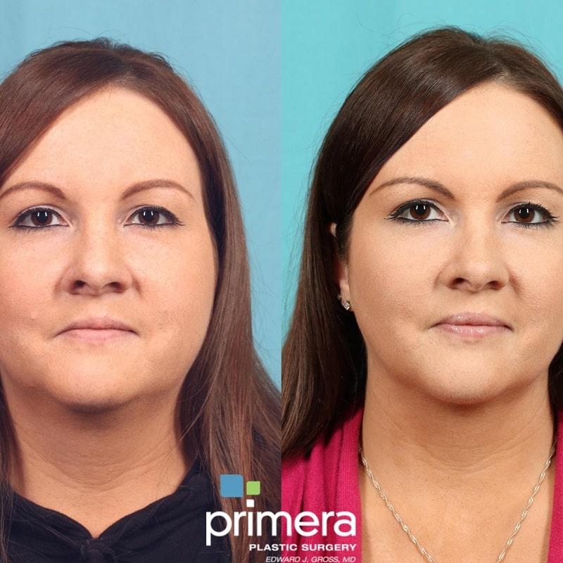 Buccal Fat Removal Before and After: What You Need to Know