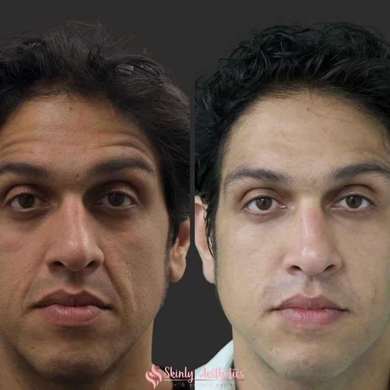 Under Eye Filler Before and After: Results and Expectations 24 Under Eye Filler Before and After: Results and Expectations