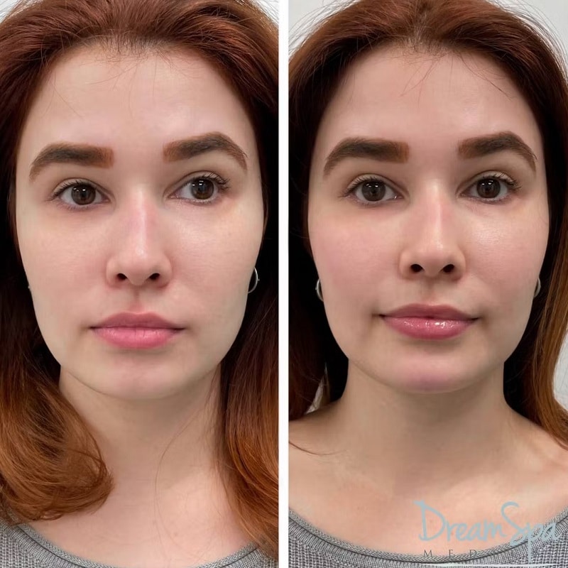 Cheek Filler Before and After: Transforming Your Appearance with Subtle Enhancements 25 Cheek Filler Before and After: Transforming Your Appearance with Subtle Enhancements