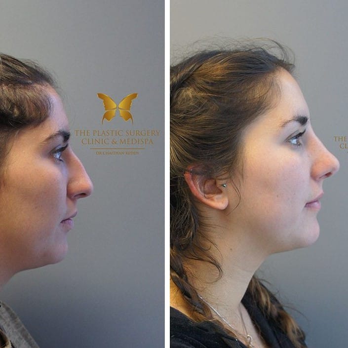 Nose Job Before and After: Dramatic Transformations and What to Expect