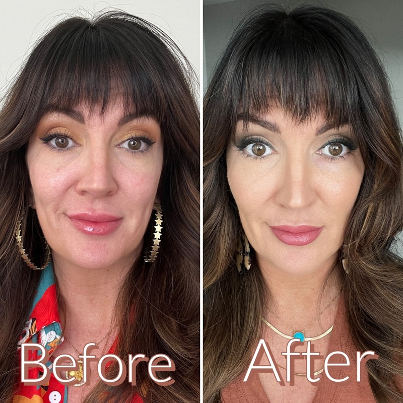 Cheek Filler Before and After: Transforming Your Appearance with Subtle Enhancements 26 Cheek Filler Before and After: Transforming Your Appearance with Subtle Enhancements