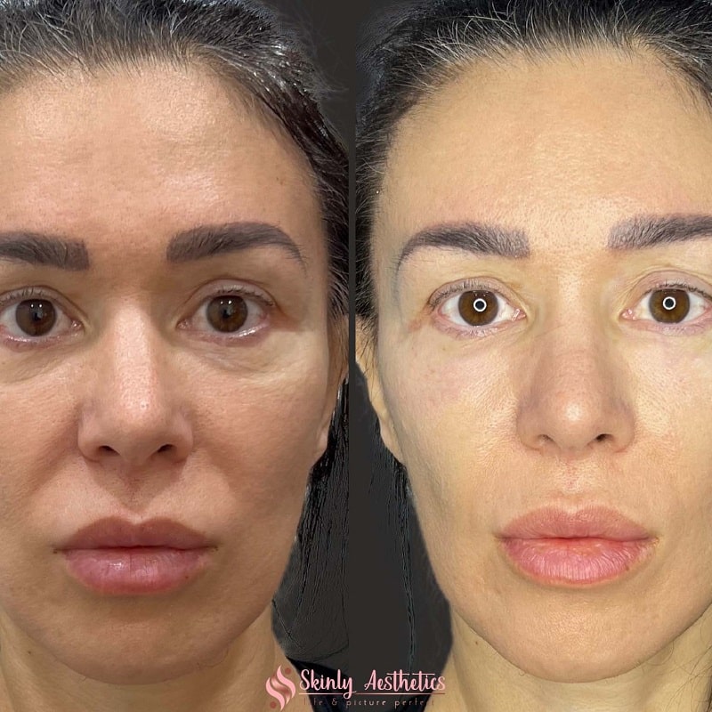 Under Eye Filler Before and After: Results and Expectations 25 Under Eye Filler Before and After: Results and Expectations