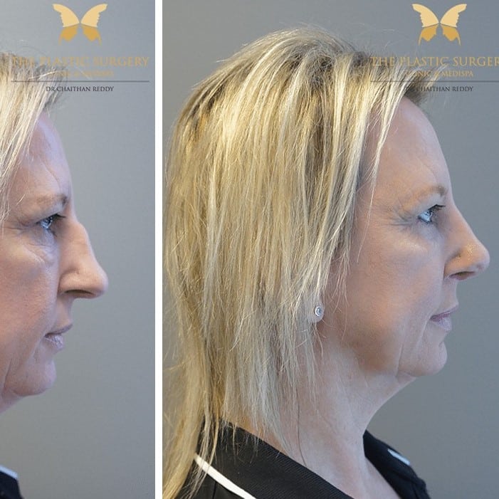 Nose Job Before and After: Dramatic Transformations and What to Expect