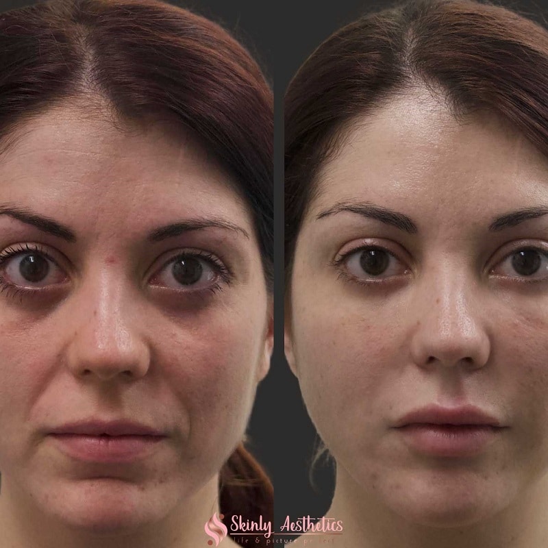 Under Eye Filler Before and After: Results and Expectations 26 Under Eye Filler Before and After: Results and Expectations