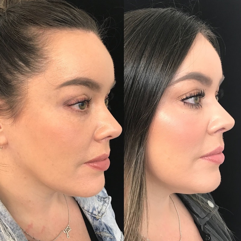 Cheek Filler Before and After: Transforming Your Appearance with Subtle Enhancements 27 Cheek Filler Before and After: Transforming Your Appearance with Subtle Enhancements