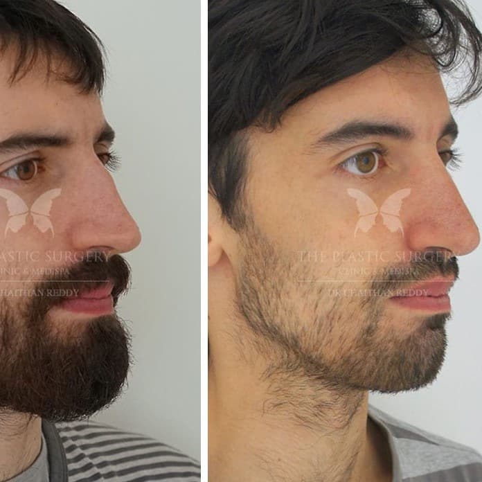 Nose Job Before and After: Dramatic Transformations and What to Expect