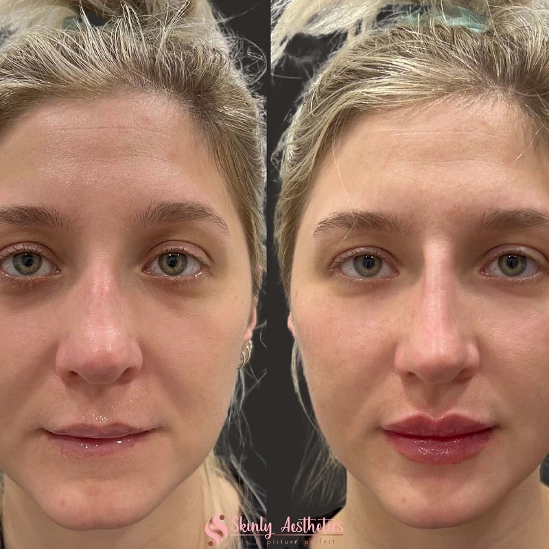 Under Eye Filler Before and After: Results and Expectations 27 Under Eye Filler Before and After: Results and Expectations