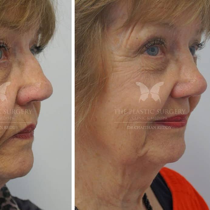 Nose Job Before and After: Dramatic Transformations and What to Expect