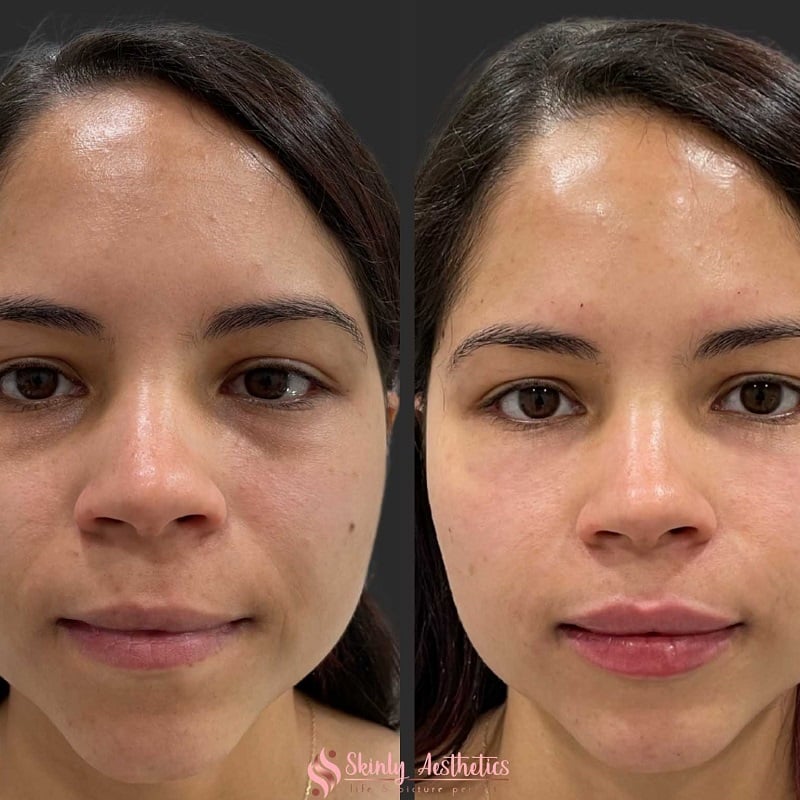 Under Eye Filler Before and After: Results and Expectations 28 Under Eye Filler Before and After: Results and Expectations